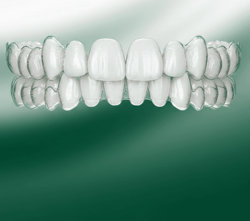 Clear Aligners