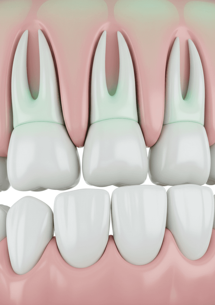 Gum Treatment (or Periodontal Treatment)
