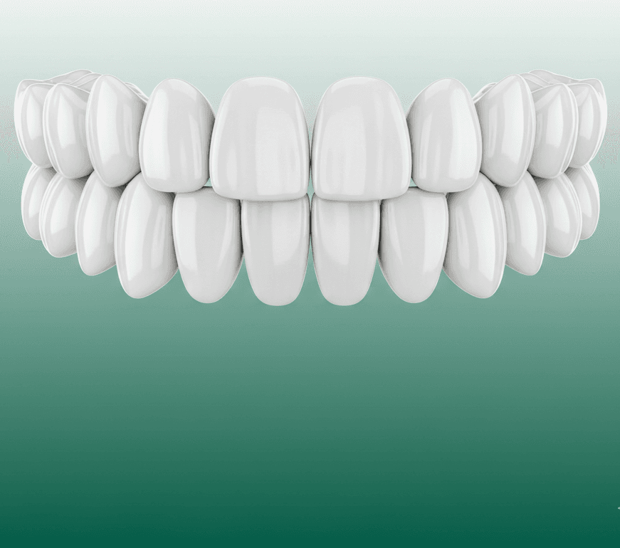 Porcelain Veneers